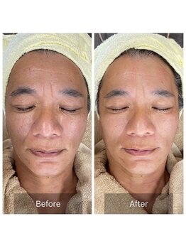 サロン ルイス アディクト(salon Lewis Addict)/【タイトニング】肌の引き締め!