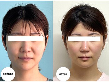 グランルーツ(GranRoots)/小顔矯正before/after