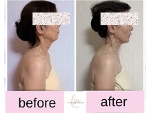 ルミライズヴィブリス(lumirise vibliss)/小顔矯正 2回目