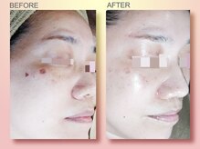 ジュリア オージェ 梅田店/ビフォーアフター（シミケア）