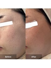 モカ 天王寺店(MOKA)/剥離2回目　くすみ　ニキビケア