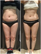 アイスタイル(i-style)/脂肪冷却/痩身ダイエット/泉大津