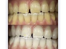 セルフダック 宮城角田店(SELFDUCK)/セルフホワイトニング症例写真