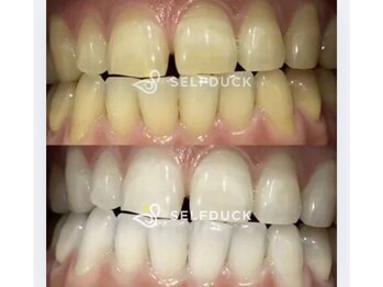 セルフダック 宮城角田店(SELFDUCK)/セルフホワイトニング症例写真