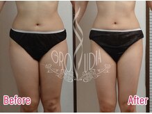 グラウディア 恵比寿/痩身/筋膜リリース/インディバ超