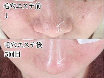 ニュートラル(neutral)/毛穴エステを続けた結果のお肌