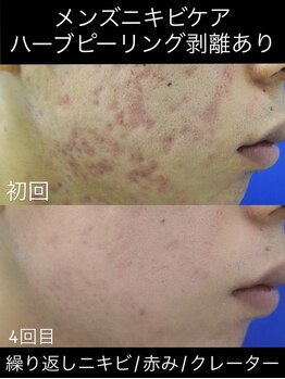 ソアン(Soin)/メンズフェイシャルケア