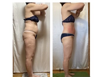 エステサロン ロティオンの写真/なかなか落としにくい気になるお腹の脂肪を撃退☆効率よく脂肪にアプローチして理想のくびれを手に入れる！