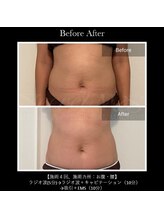 ナチュラル ビューティー ベルポート(natural beauty Bellport)/シークレットmesお腹4回施術