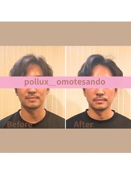 ポルクス鍼灸整骨院 表参道(Pollux鍼灸整骨院)/鍼灸 整体 美容鍼灸