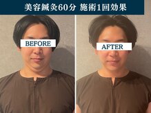 シンク(CINQ)/美容鍼灸60分二重顎肩首こり鍼灸