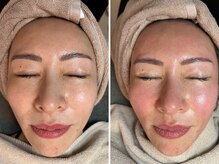 ワンネス(oneness)の雰囲気（効果を実感！ドライピーリングマシンで美肌へ☆）