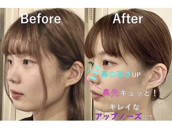 ラプリ 大宮店(Raplit)/隆鼻＋輪郭矯正40分10回