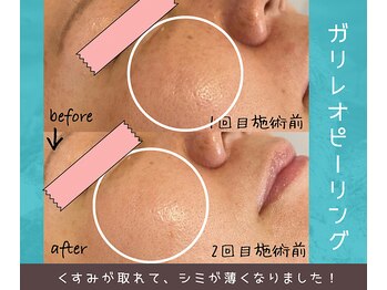 マーヤ(Ma-ya)/ガリレオピーリング