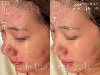 ベル 広島(Belle)/ハーブピーリング｜ニキビケア
