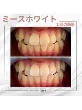 ミースホワイトニング(mys whitening)/ビフォーアフター【歯科提携】