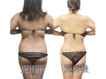エリクシア 松戸/40代全身痩身12回目(お腹と背中)