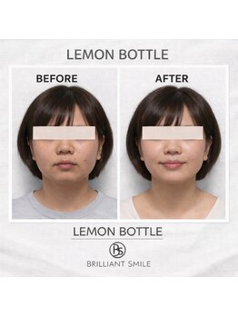 ブリリアントスマイル/レモンボトルで小顔