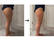 ドクターエイジレス(DR.AGELESS)/脂肪ケア剤導入コース1回