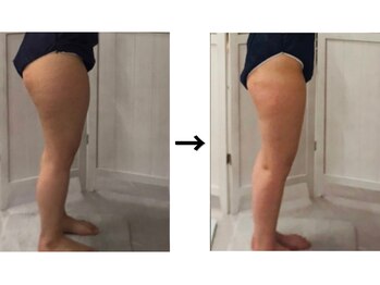 ドクターエイジレス(DR.AGELESS)/脂肪ケア剤導入コース1回