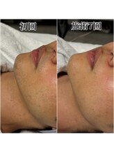 ルシャトン(Le Chaton)/ヒゲ脱毛