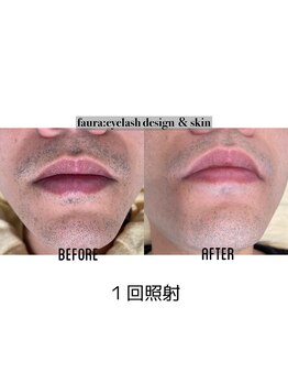 ファウラ(faura:)/【メンズ】ヒゲ脱毛