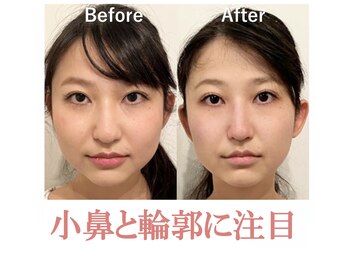 ラプリ 浜松店(Raplit)/ &nbsp;隆鼻＋輪郭矯正40分10回