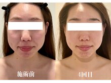 サピュイエ(S'appuyer)/むくみ解消でキュッと小顔に