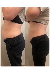 長寿鍼灸院 長寿整骨院/EMS＜お腹集中コース＞