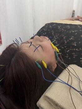 フォーユー 大和郡山院(for you)/パルスを用いた美容鍼