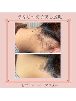 ノノ(nono)/うなじ～えりあし脱毛♪