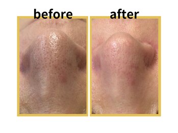 シェリール(Cherir)/肌質改善+毛穴洗浄