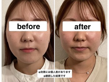 グリーン鍼灸整体院(green鍼灸整体院)/エラ撃退美容鍼