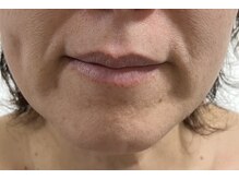 ピュアージュ/フェイシャル幹細胞導入