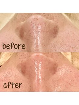 サロン クベル(Salon Kvell)/毛穴洗浄で肌トーンup