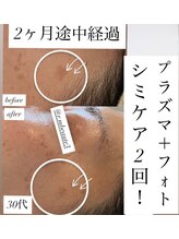 アールエム ボーテ(RM beaute')/シミケア＋プラズマ＋フォト