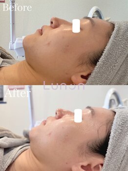 ルノン(Lunon)/毛穴洗浄ハイドロ×ララピール