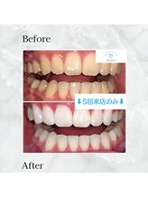 ホワイトニングサロンリセット 白金高輪(RESET)/３～5回の来店で歯の色が定着！