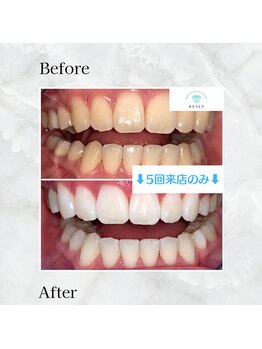 ホワイトニングサロンリセット 白金高輪(RESET)/３～5回の来店で歯の色が定着！