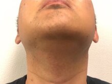 リル(RILU)/【脱毛】ヒゲ(after)