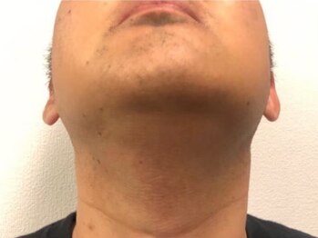 リル(RILU)/【脱毛】ヒゲ(after)