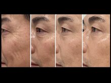 ミルジュ(MiLuJu)/AC トリートメントBefore→After