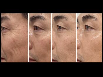 ミルジュ(MiLuJu)/AC トリートメントBefore→After