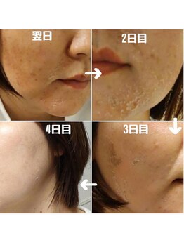 レイ(Rei)/ハーブピーリング過程