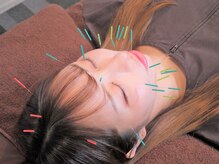 最終形美/美容鍼で小顔になりましょう