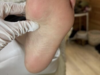 ネイルファブ(NAIL FAV)の写真/【太宰府/駐車場あり】ガサガサの足裏をつるつるすべすべに★《足裏フットケア◇角質除去¥2,000》