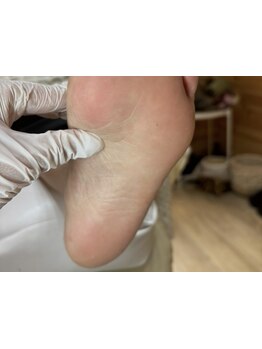 角質ケアができるサロン