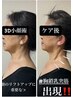 お誕生月特典【3D筋膜小顔術90分】