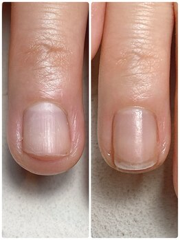 スマイルニコ(smile nico)/深爪矯正　自爪育成