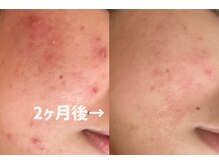 お肌さろん れふぇるんの雰囲気（ニキビ肌も得意でブライダルエステも人気♪）